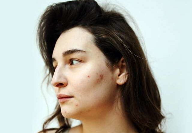 Treat and Preventing Acne Scars