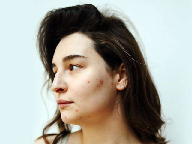 Treat and Preventing Acne Scars